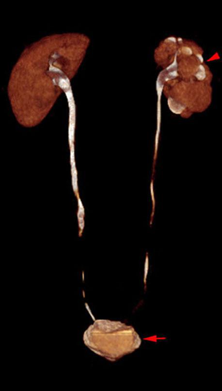 Pielonefritis crónica en tbc