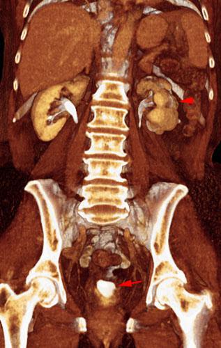 Pielonefritis crónica en tbc