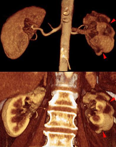 Pielonefritis crónica en tbc