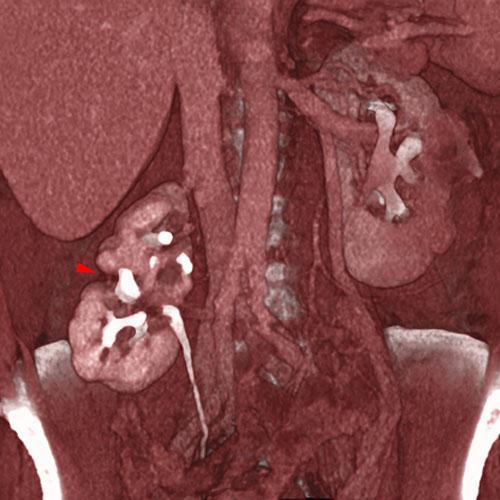 Riñón ectópico pielonefrítico