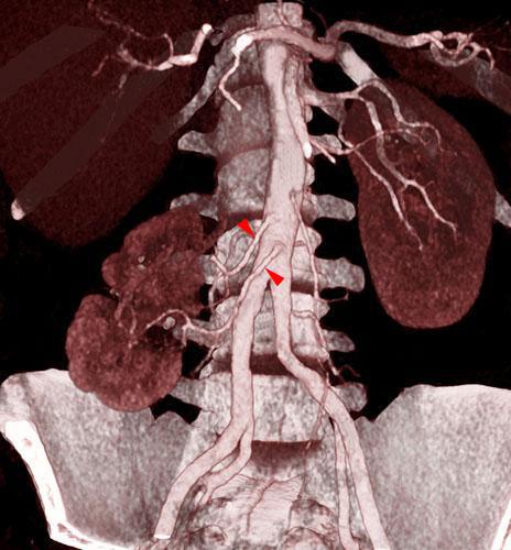 Riñón ectópico pielonefrítico