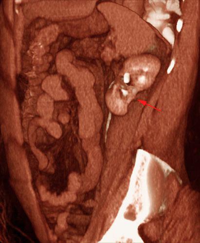 Pielonefritis crónica