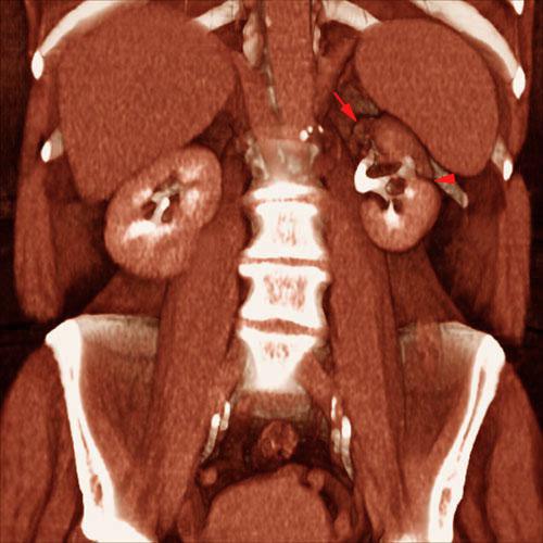 Pielonefritis crónica