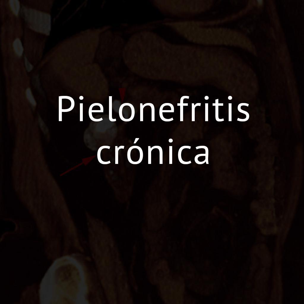 Pielonefritis crónica
