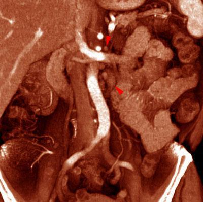 Pielonefritis xantogranulomatosa