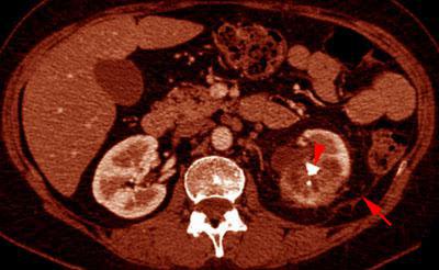 Pielonefritis xantogranulomatosa
