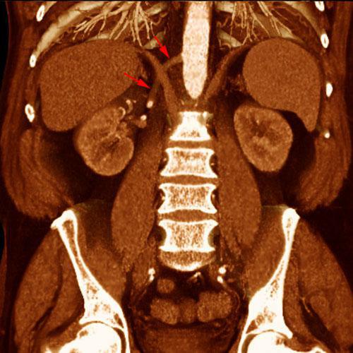 Arteria renal torácica
