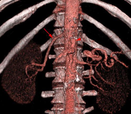 Arteria renal torácica