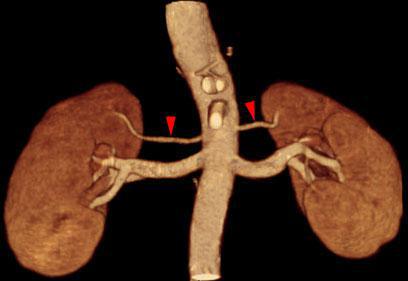 Arterias renales polares