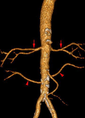 Arterias renales accesorias