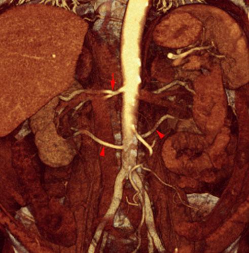 Arterias renales accesorias