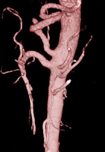 Arterias renales múltiples