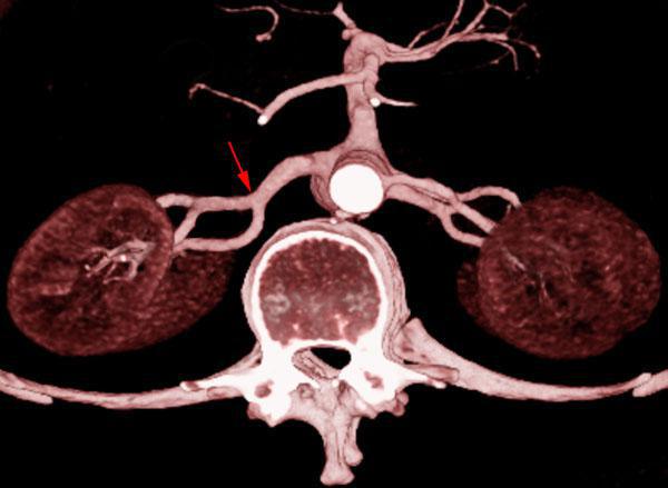 Arterias renales múltiples