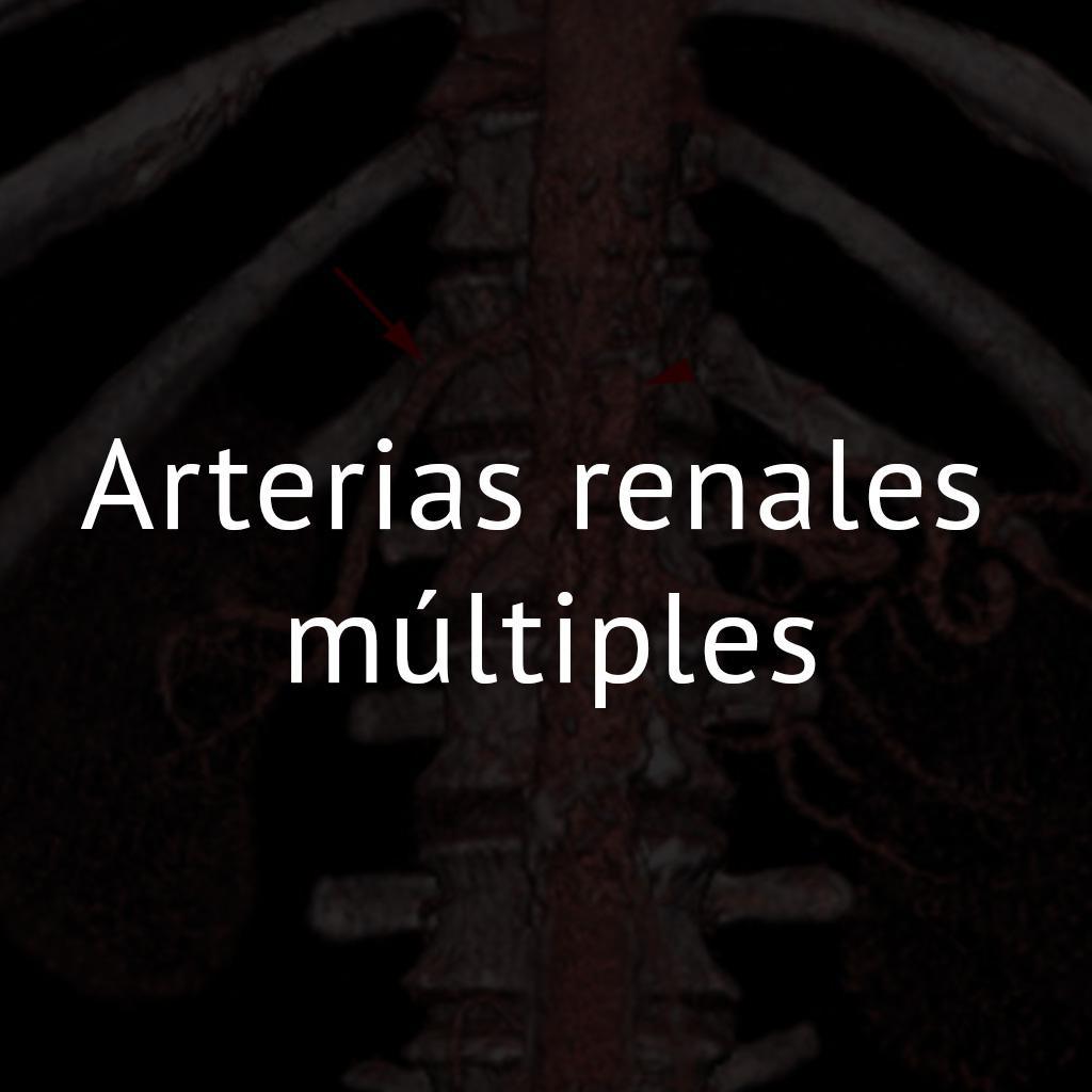 Arterias renales múltiples
