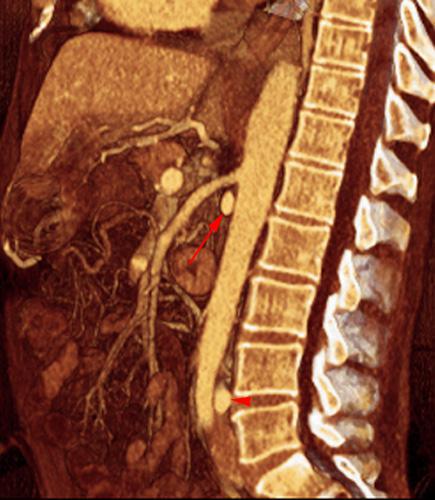 Vena renal izquierda circumaórtica baja