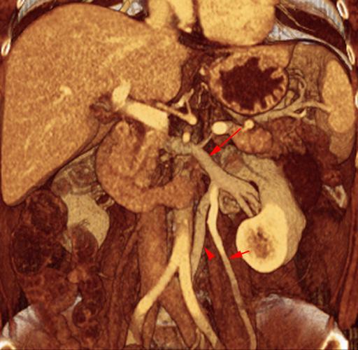 Vena renal izquierda circumaórtica baja