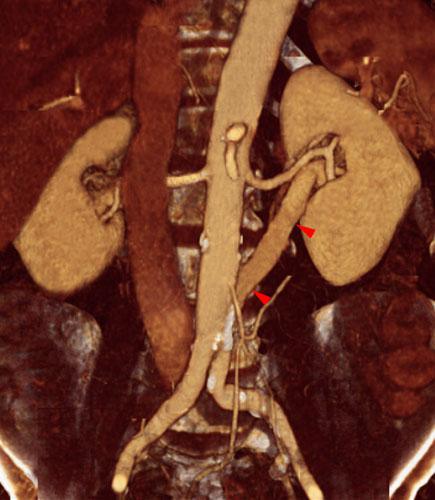 Vena renal izquierda retroaórtica baja
