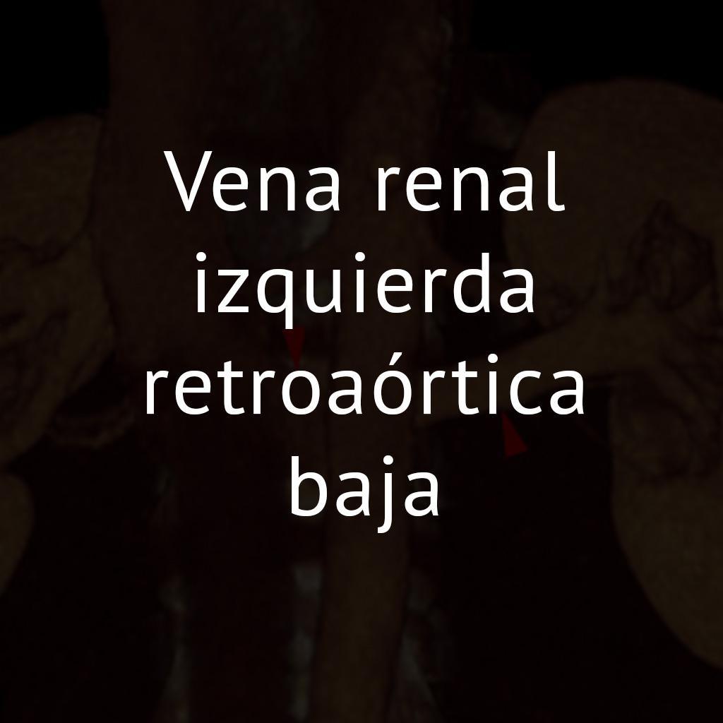 Vena renal izquierda retroaórtica baja