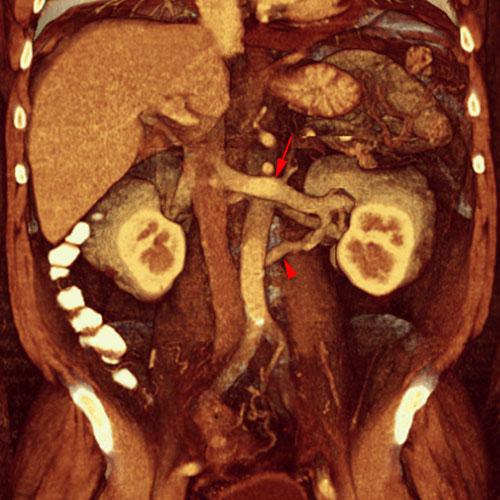 Vena renal izquierda circumaórtica
