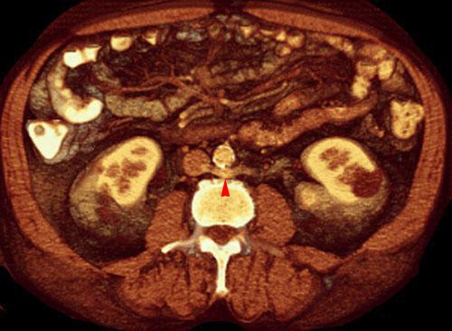 Vena renal izquierda circumaórtica