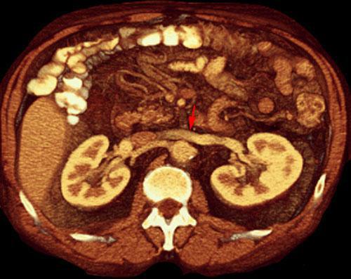 Vena renal izquierda circumaórtica