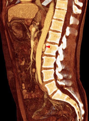 Vena renal izquierda retroaórtica