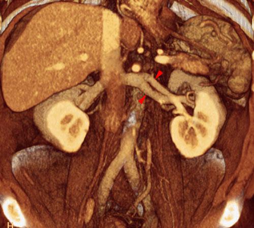 Bifurcación vena renal izquierda