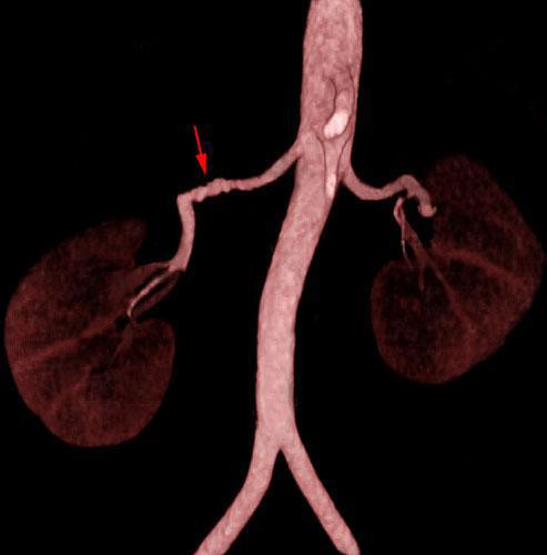 Estenosis por displasia fibromuscular de arterias renales