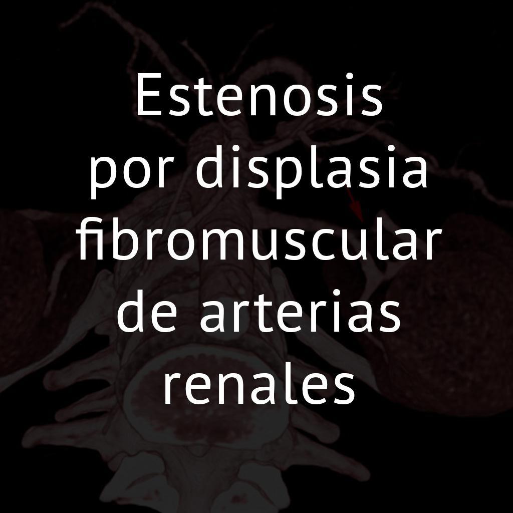 Estenosis por displasia fibromuscular de arterias renales