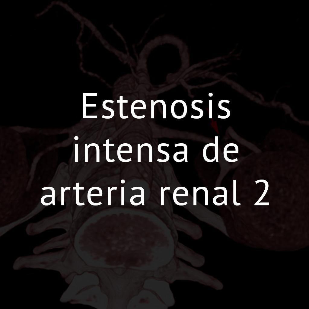 Estenosis intensa de arteria renal 2