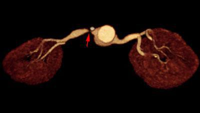 Estenosis intensa de arteria renal 1