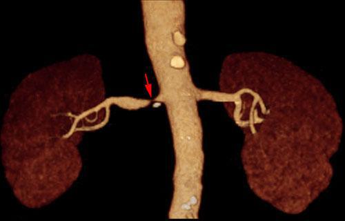 Estenosis intensa de arteria renal 1