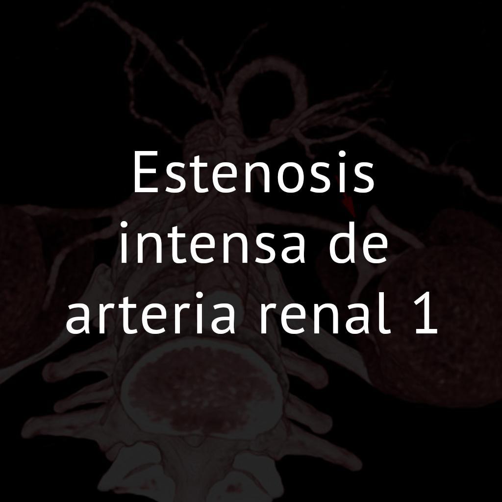 Estenosis intensa de arteria renal 1