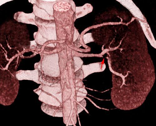 Estenosis moderada de arteria renal