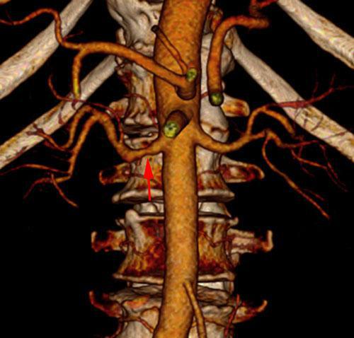 Estenosis moderada de arteria renal