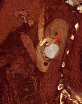 Aneurisma de arteria renal en monorreno