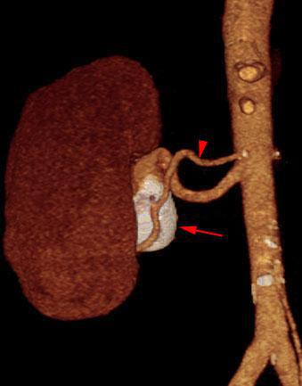 Aneurisma de arteria renal en monorreno