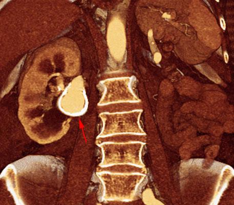 Aneurisma de arteria renal en monorreno