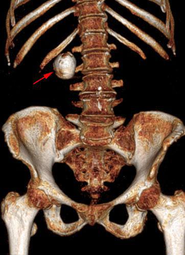 Aneurisma de arteria renal en monorreno