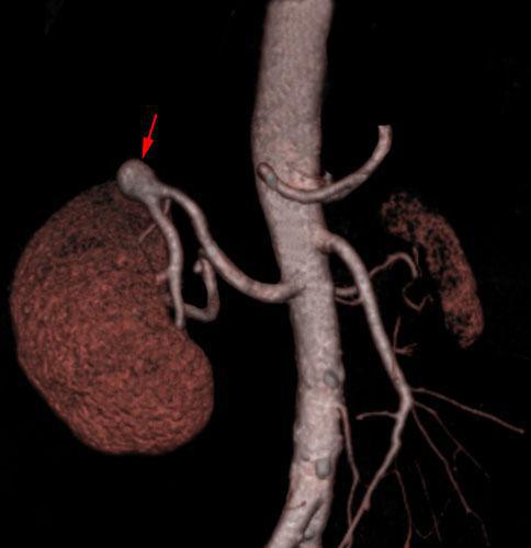 Aneurisma de arteria renal 2