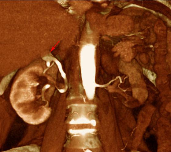 Aneurisma de arteria renal 2