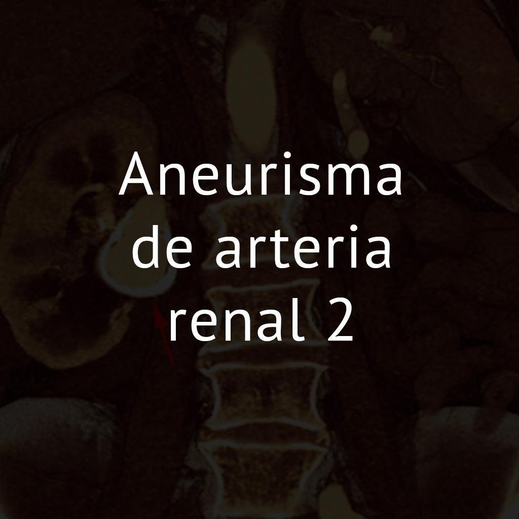 Aneurisma de arteria renal 2
