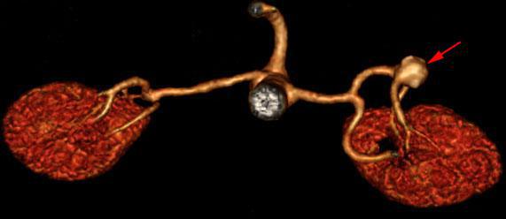 Aneurisma de arteria renal 1