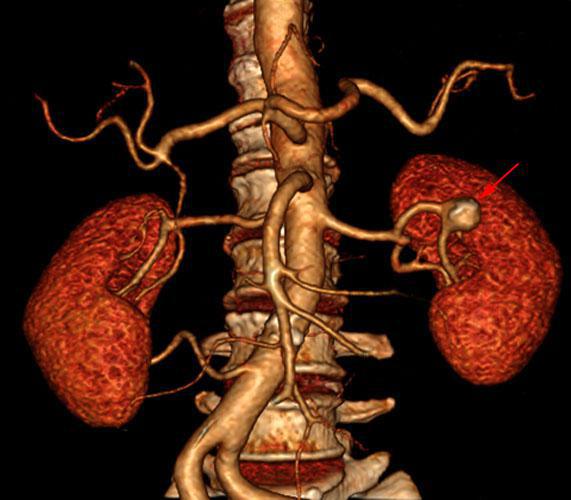 Aneurisma de arteria renal 1