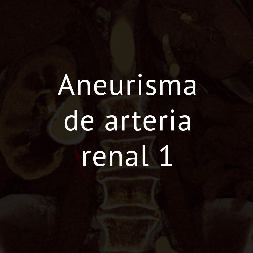 Aneurisma de arteria renal 1