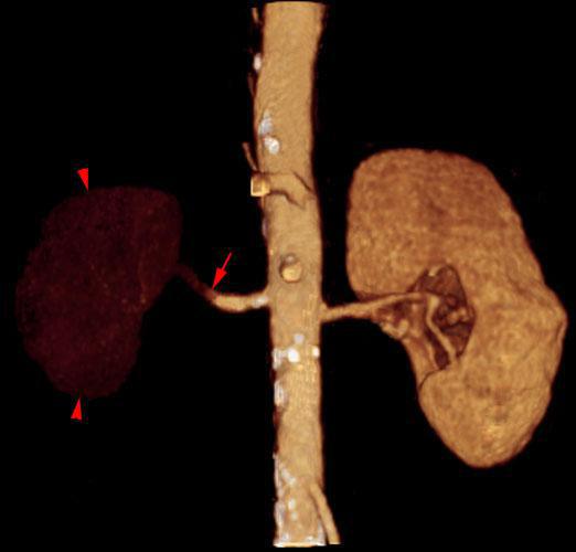 Infarto renal agudo