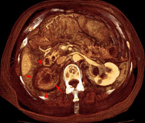 Infarto renal agudo