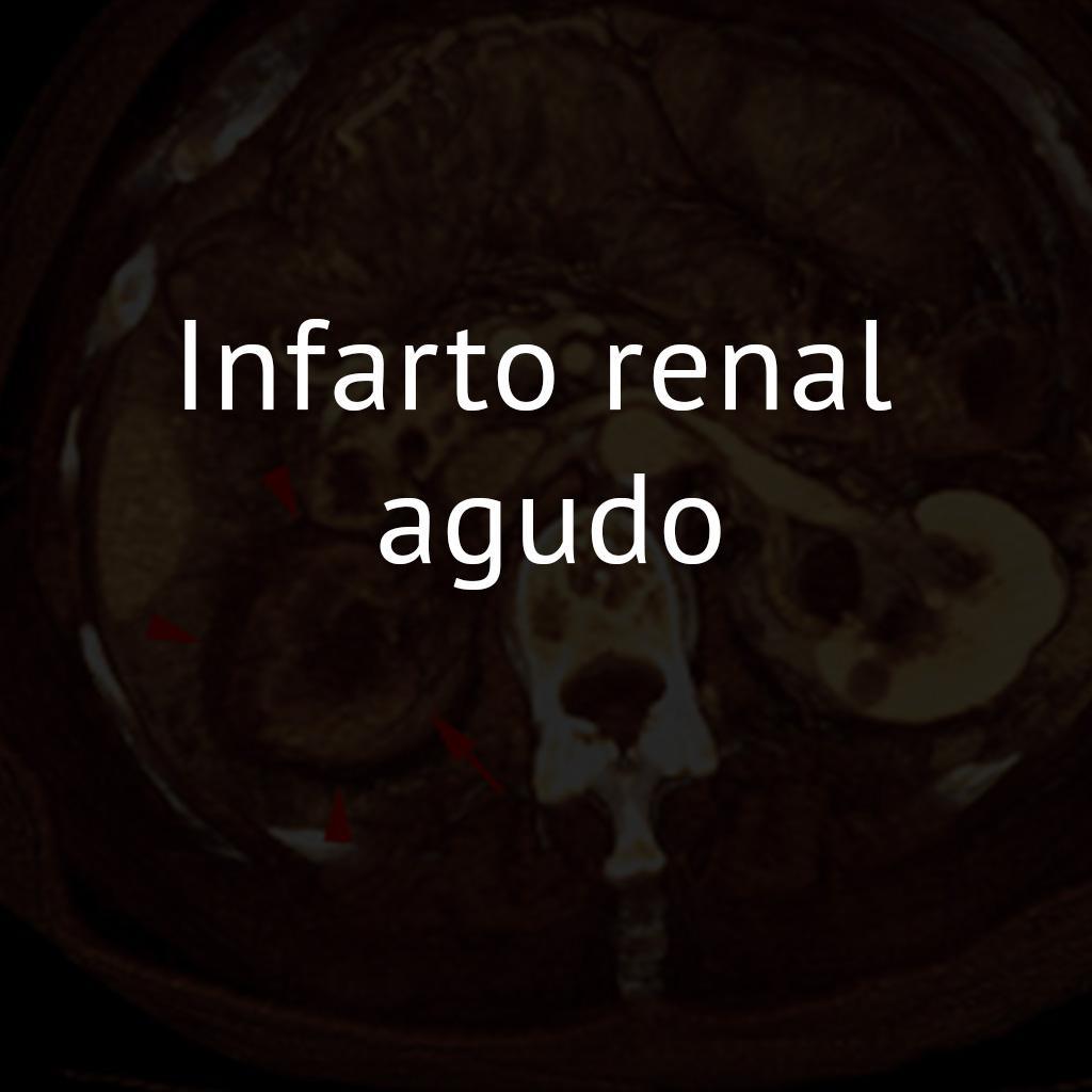 Infarto renal agudo