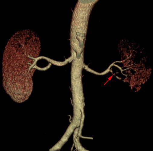 Infarto renal segmentario