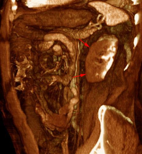 Infarto renal segmentario